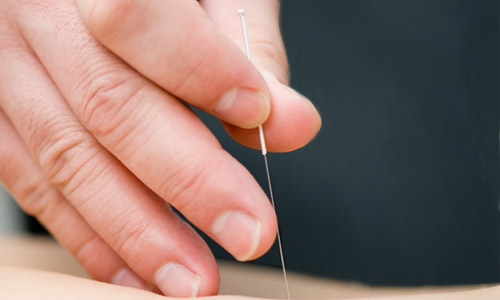 Dry Needling Available